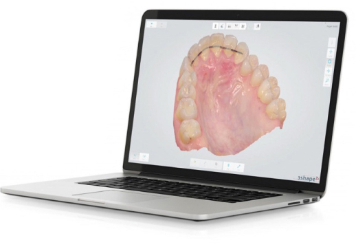 Silver laptop displaying an interoral scan